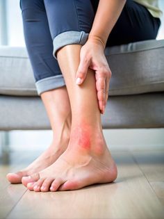 Person holding their ankle with a red rash and swelling