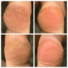 Before and after comparison of cracked heels showing improvement