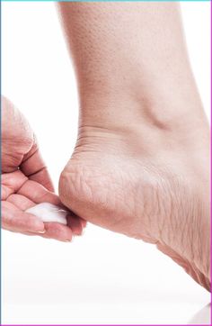 Hand applying moisturizer to a dry, cracked heel on a white background
