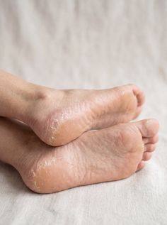 Close up of feet with dry, cracked skin on the heels