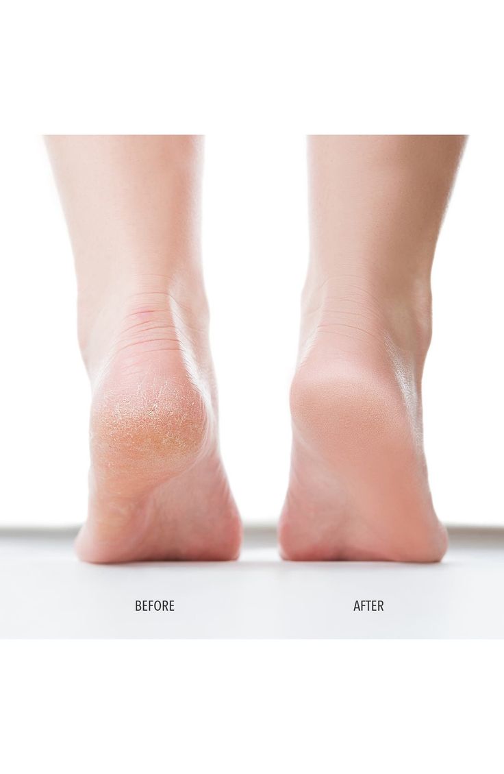 Comparison of a cracked heel before and after treatment