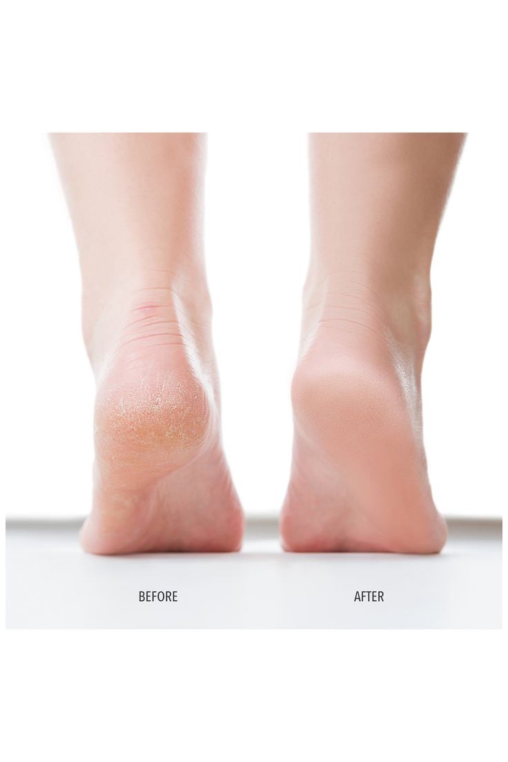 Comparison of a cracked heel and a smooth heel, labeled before and after