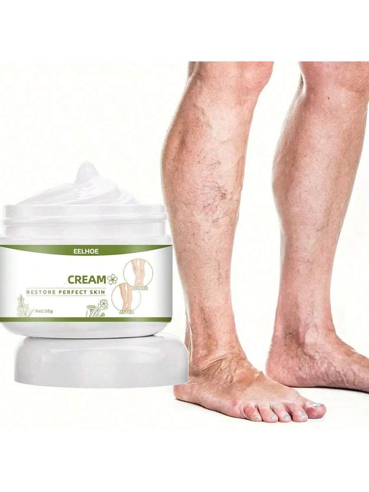 Cream jar next to legs with varicose veins, showing before and after results