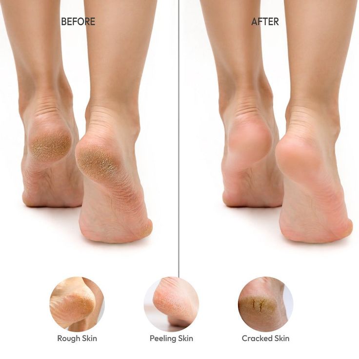 Before and after comparison of feet with cracked and dry skin